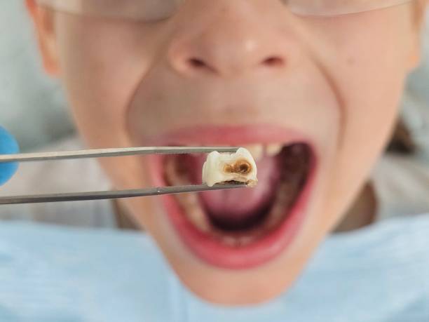 Best Emergency Tooth Extraction  in Fairforest, SC